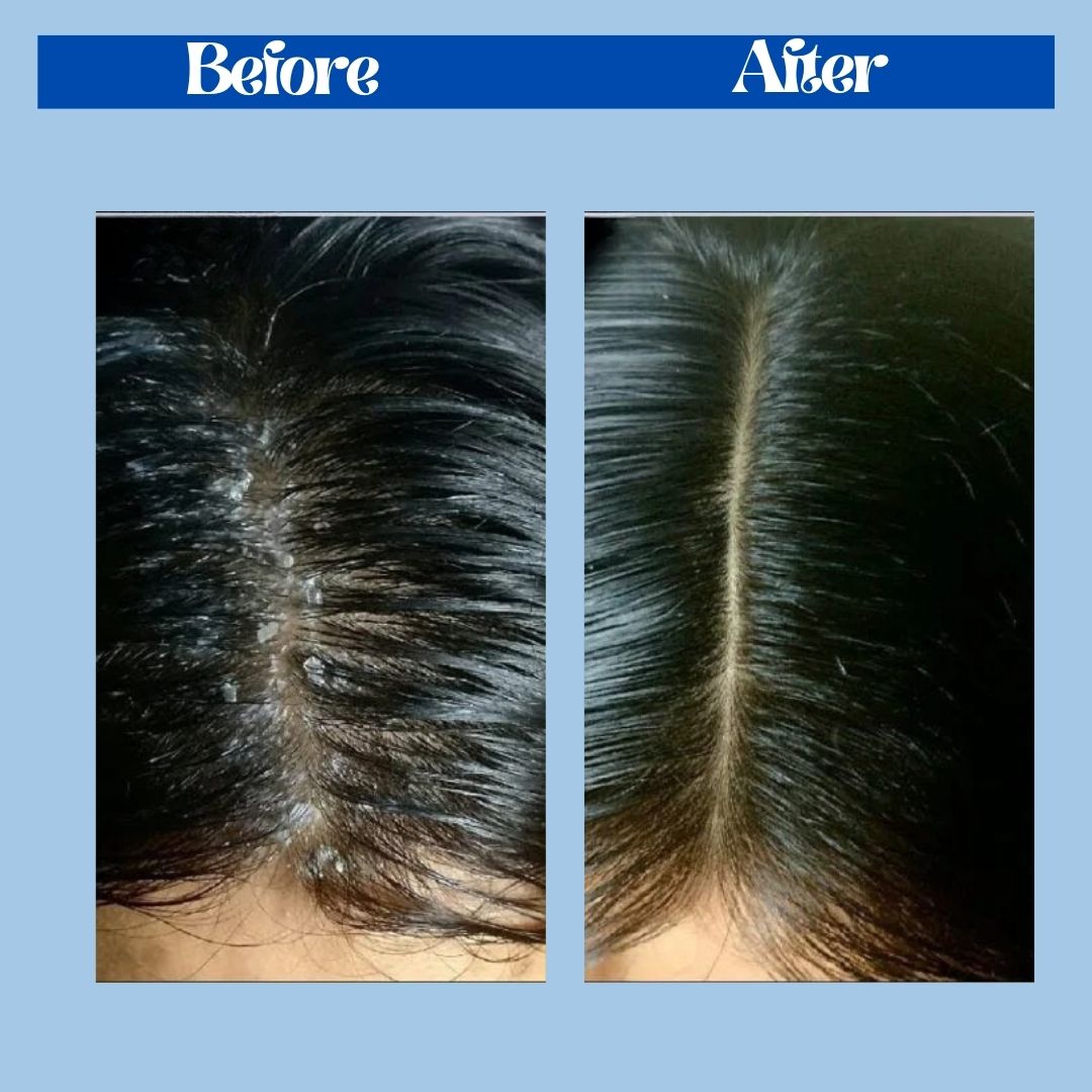 "Powder-to-foam vegan anti-dandruff shampoo with tea tree oil, salicylic acid, and zinc PCA for itchy scalp"